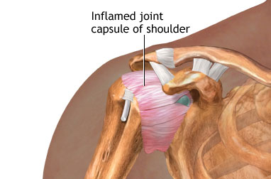 new research on frozen shoulder